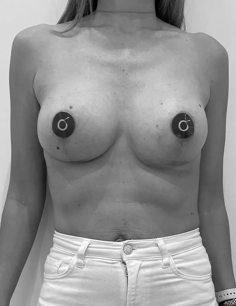 aumento con protesis d2