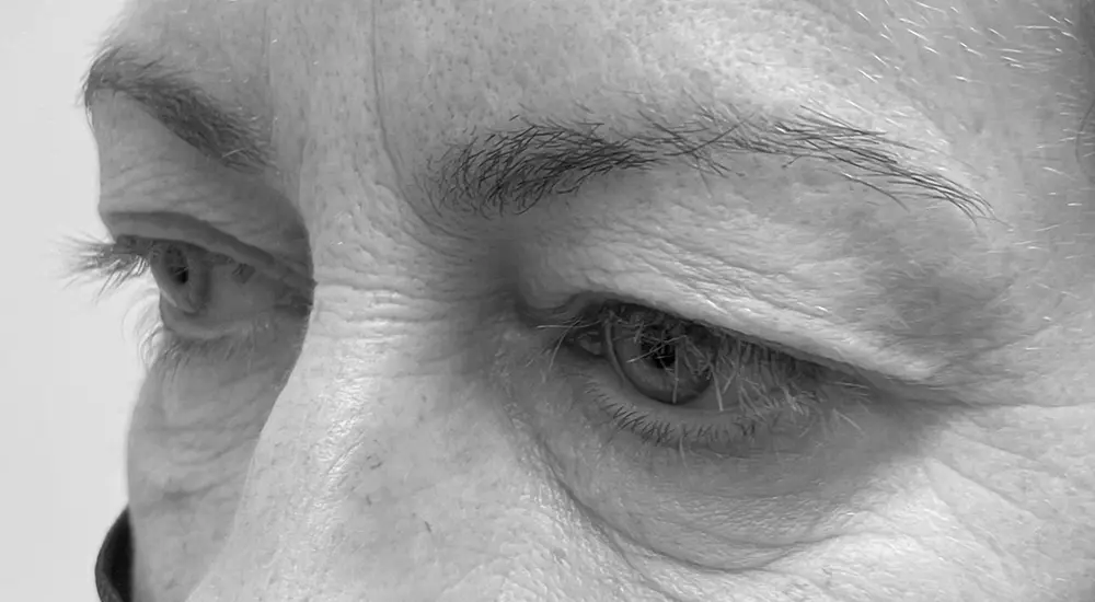 blefaroplastia a2 blefaroplastia a2