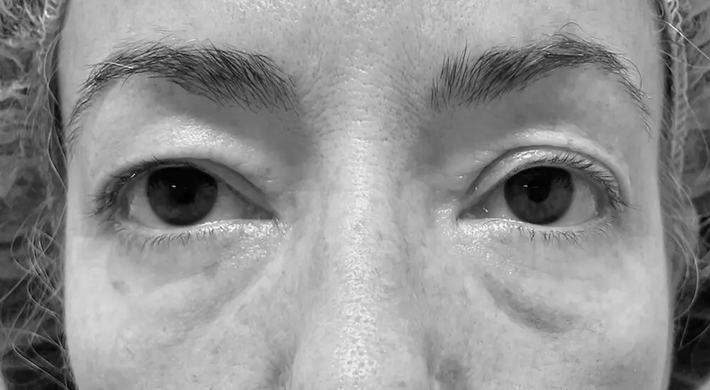 blefaroplastia b2 blefaroplastia b2