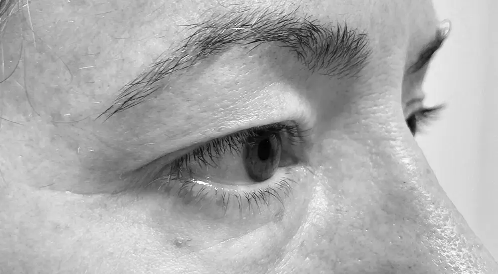 blefaroplastia c2 blefaroplastia c2