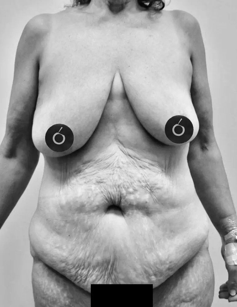 Cirugía Post-Bariátrica Cirugía Post-Bariátrica