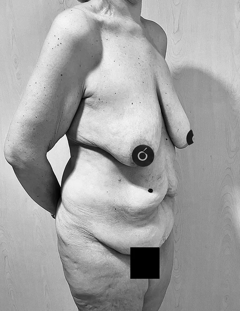 Cirugía Post-Bariátrica Cirugía Post-Bariátrica