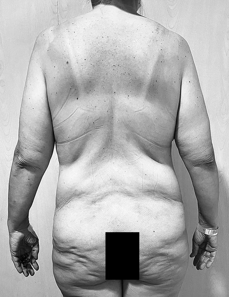 Cirugía Post-Bariátrica Cirugía Post-Bariátrica