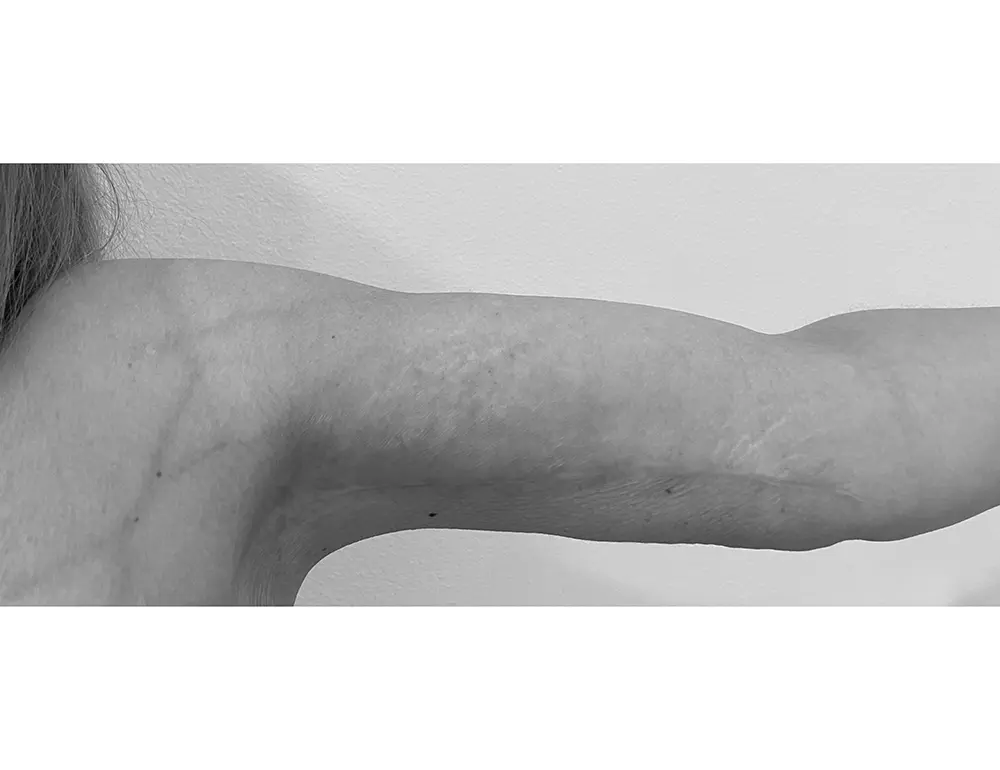 Cirugía Post-Bariátrica