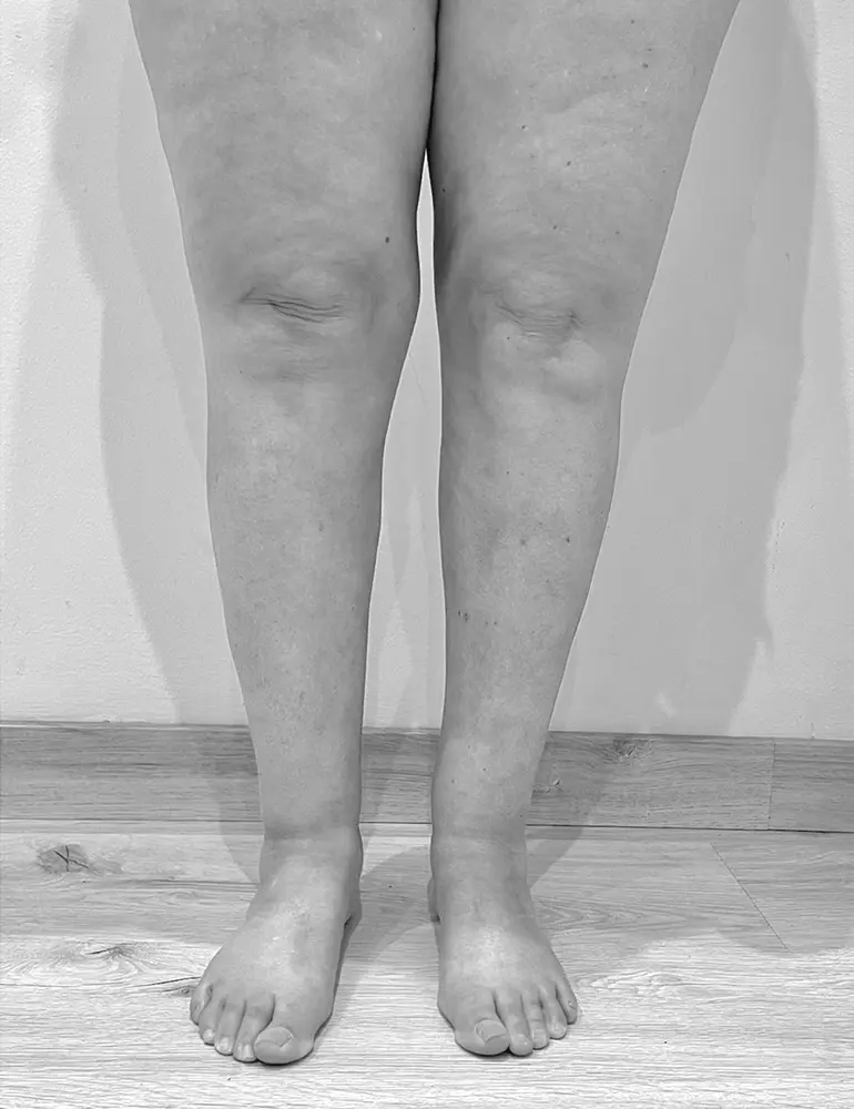 lipedema a2