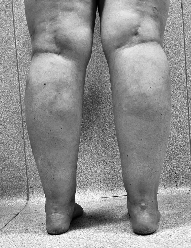 lipedema antes del tratamiento con Clínica Brasó
