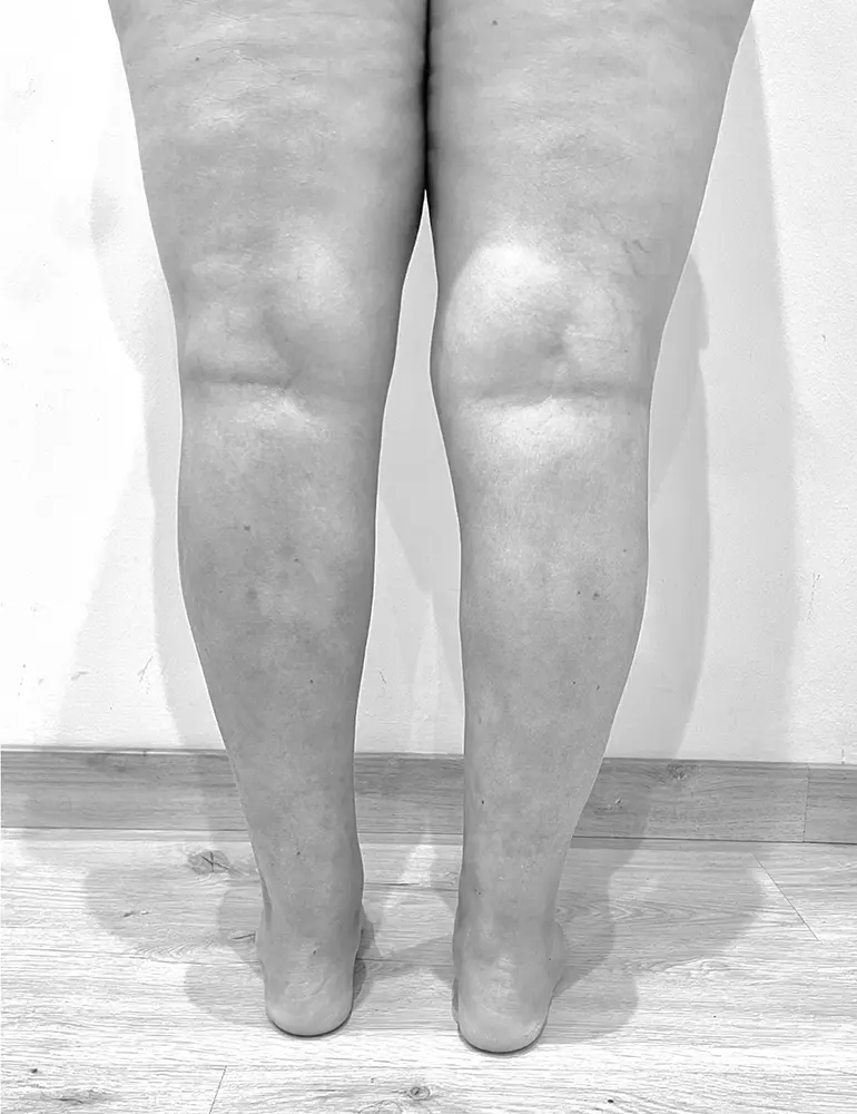 lipedema después del tratamiento con Clínica Brasó