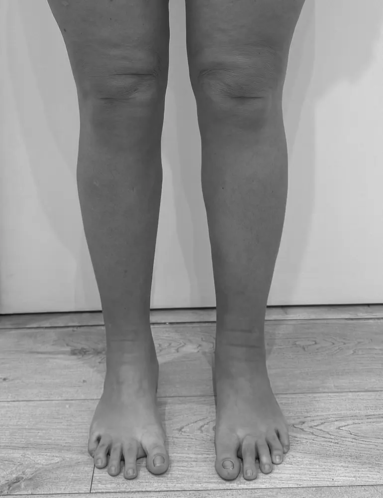 lipedema c2