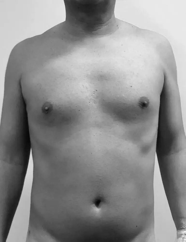 liposculpt4d+ hombre