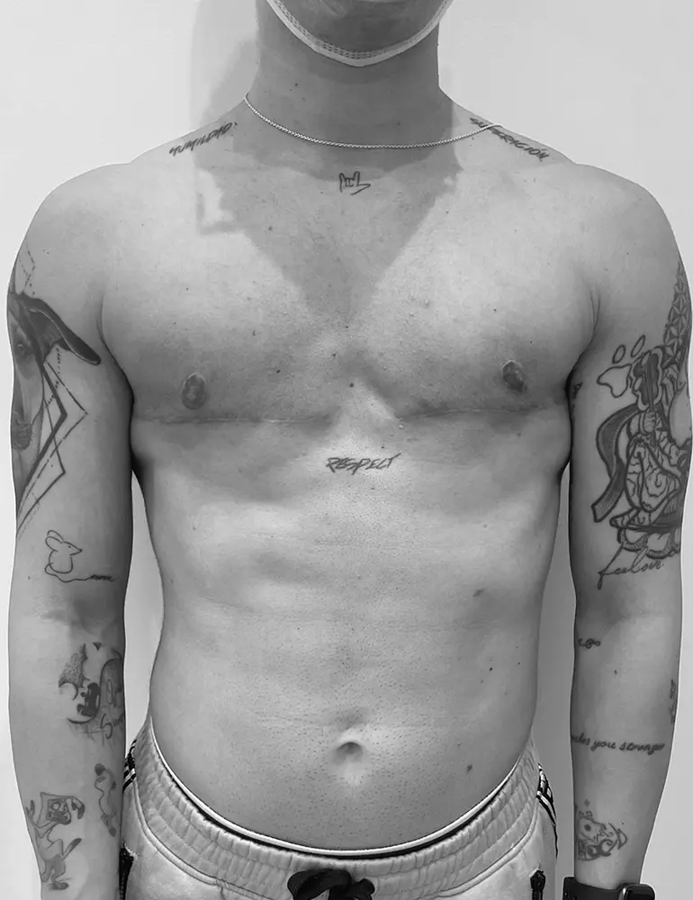 mastectomia horizontal a1