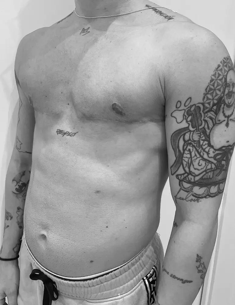 mastectomia horizontal b1