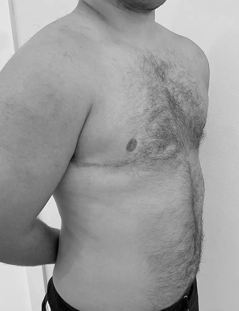 mastectomia horizontal c1