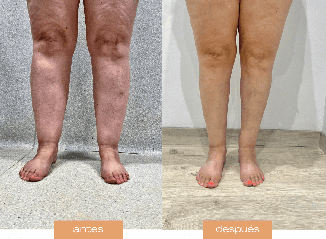 lipo c efectos secundarios Lipedema: Consecuencias físicas y emocionales Carlyle Magnesium Glycinate | Size:500 g Magnesium
