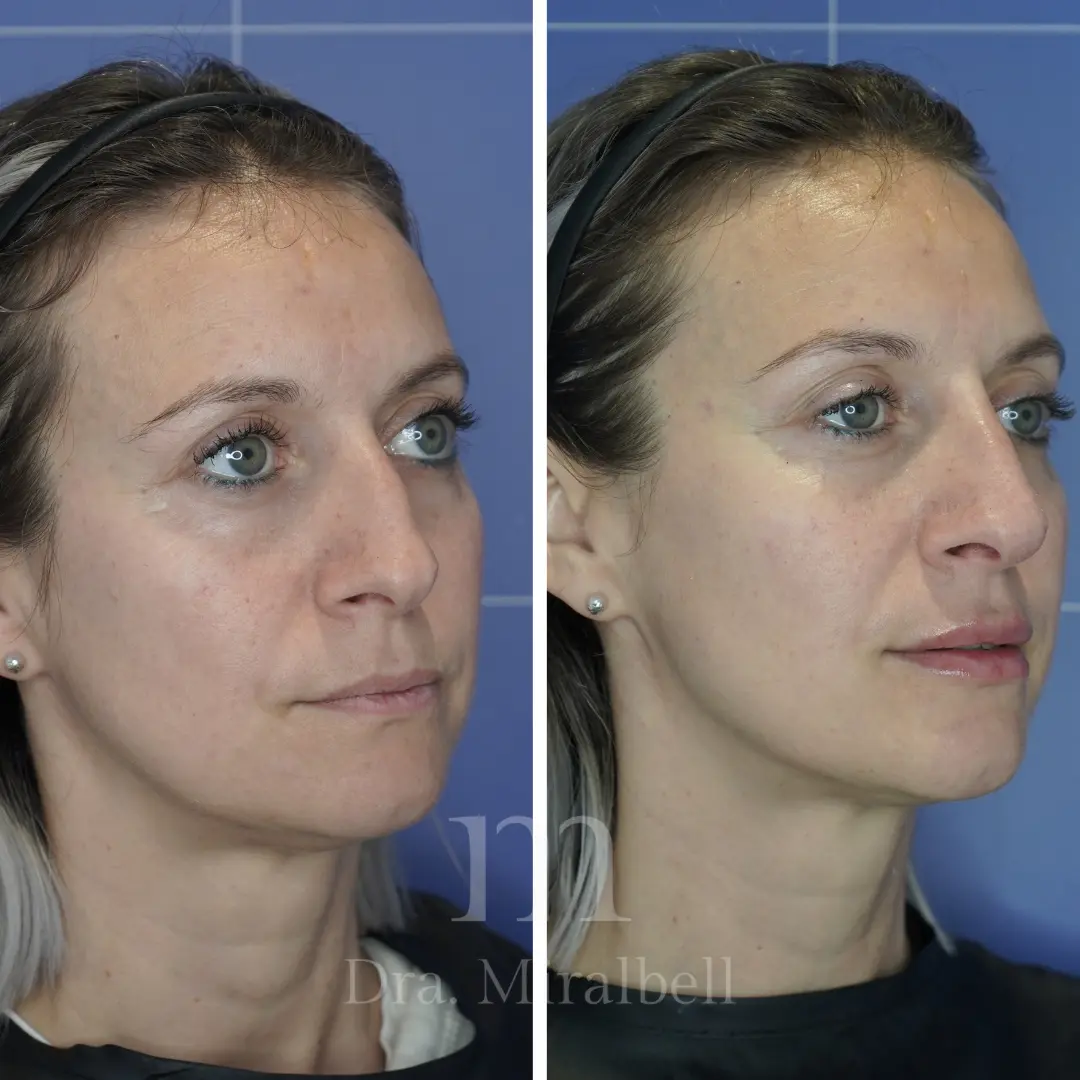 armonizacion facial 1