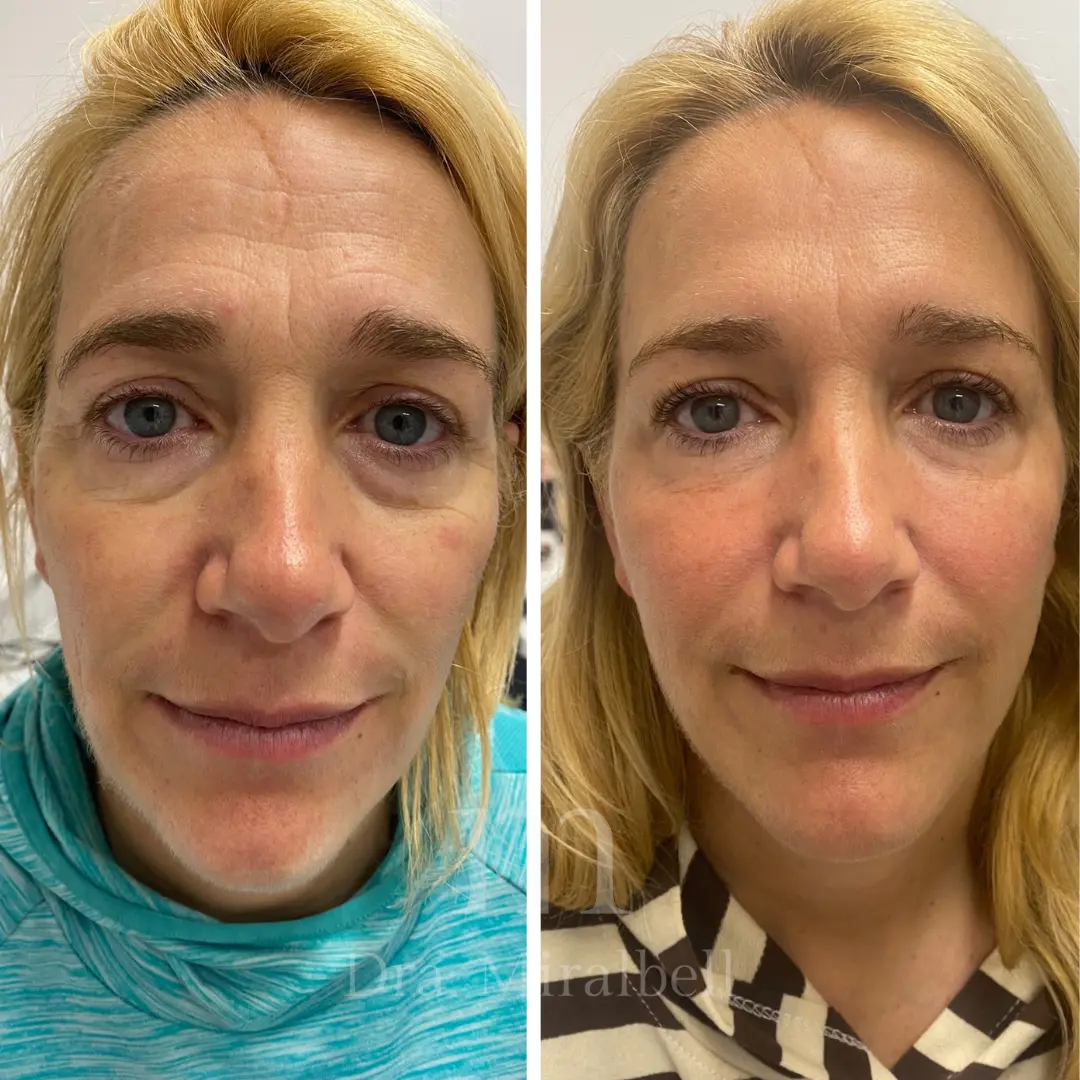 armonizacion facial 3