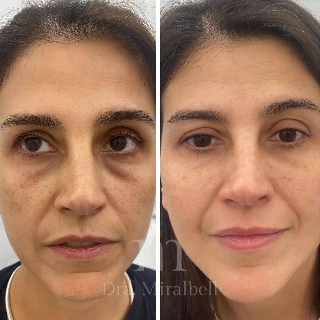 armonizacion facial 4