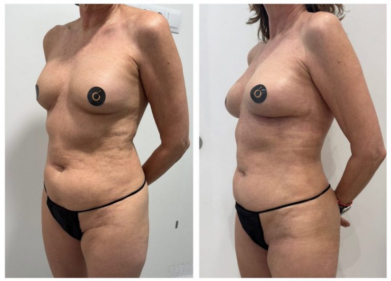 aumento de pecho con lipofilling