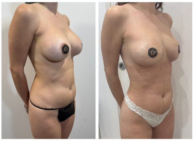 qué es el lipofilling