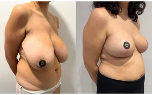 cómo se hace la reducción mamaria