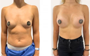 cómo elegir la talla ideal para el aumento de pecho