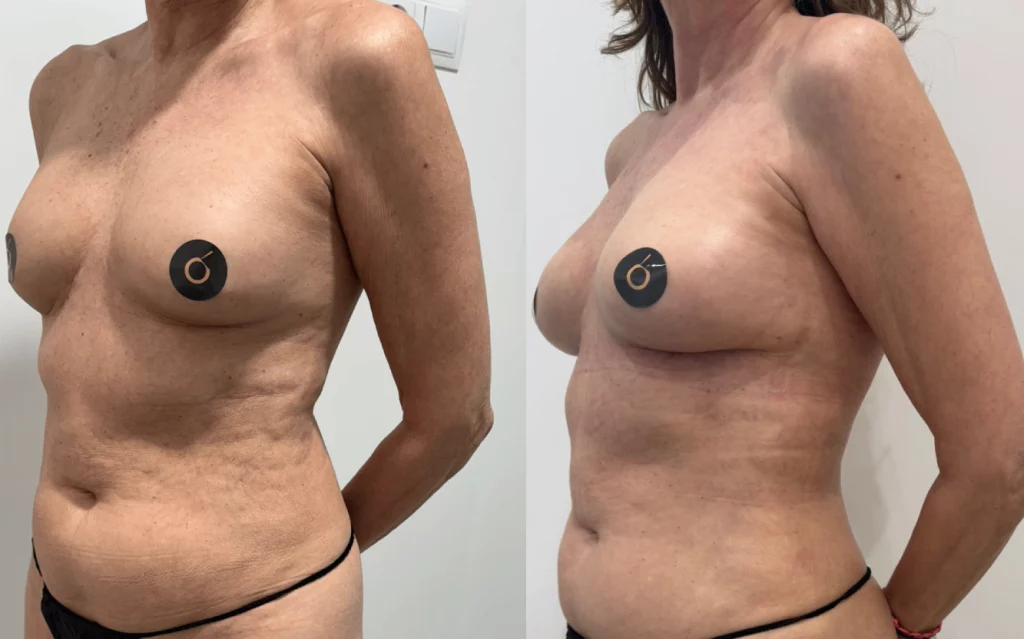 cuál es la mejor técnica de lipofilling mamario para aumento de pecho