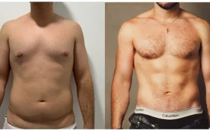 cómo se hace la lipoescultura en hombres