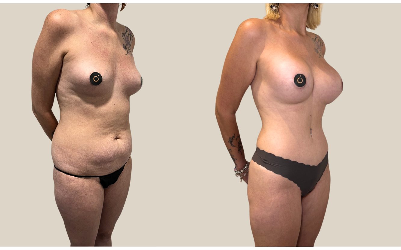 Resultado real de Mommy Makeover con remodelación mamaria postparto