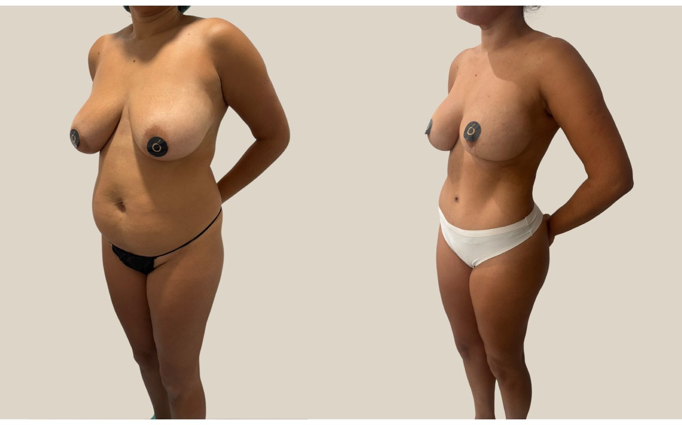 Transformación corporal completa tras Mommy Makeover en Clínica Brasó