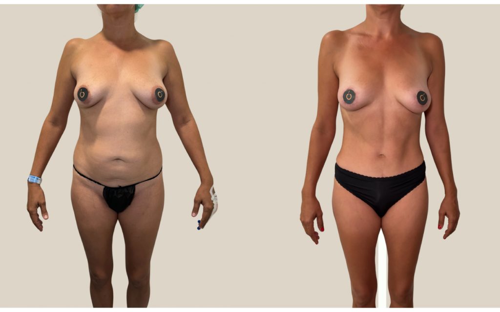 Antes y después de Mommy Makeover con abdominoplastia y liposucción