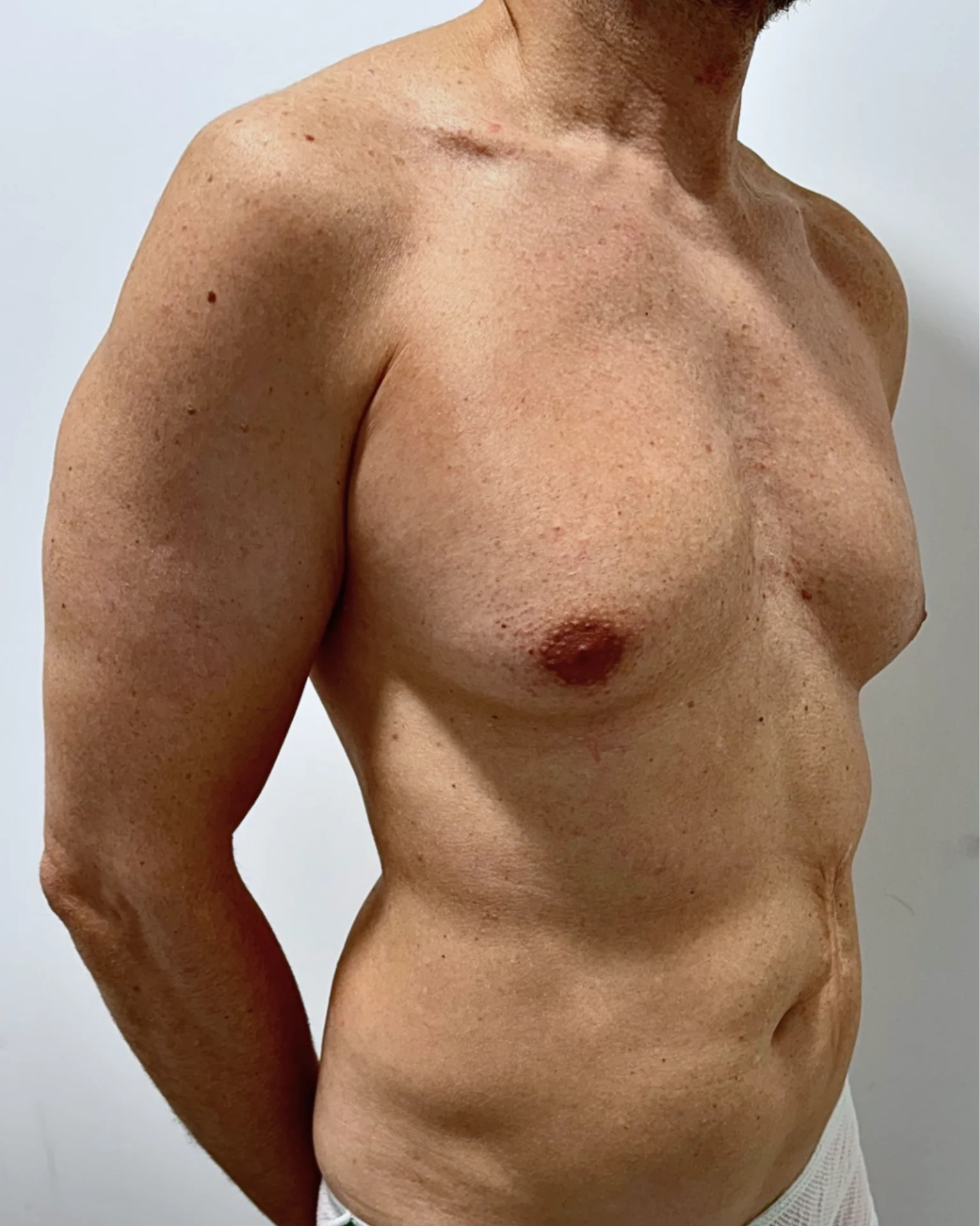 liposucción para corregir la ginecomastia