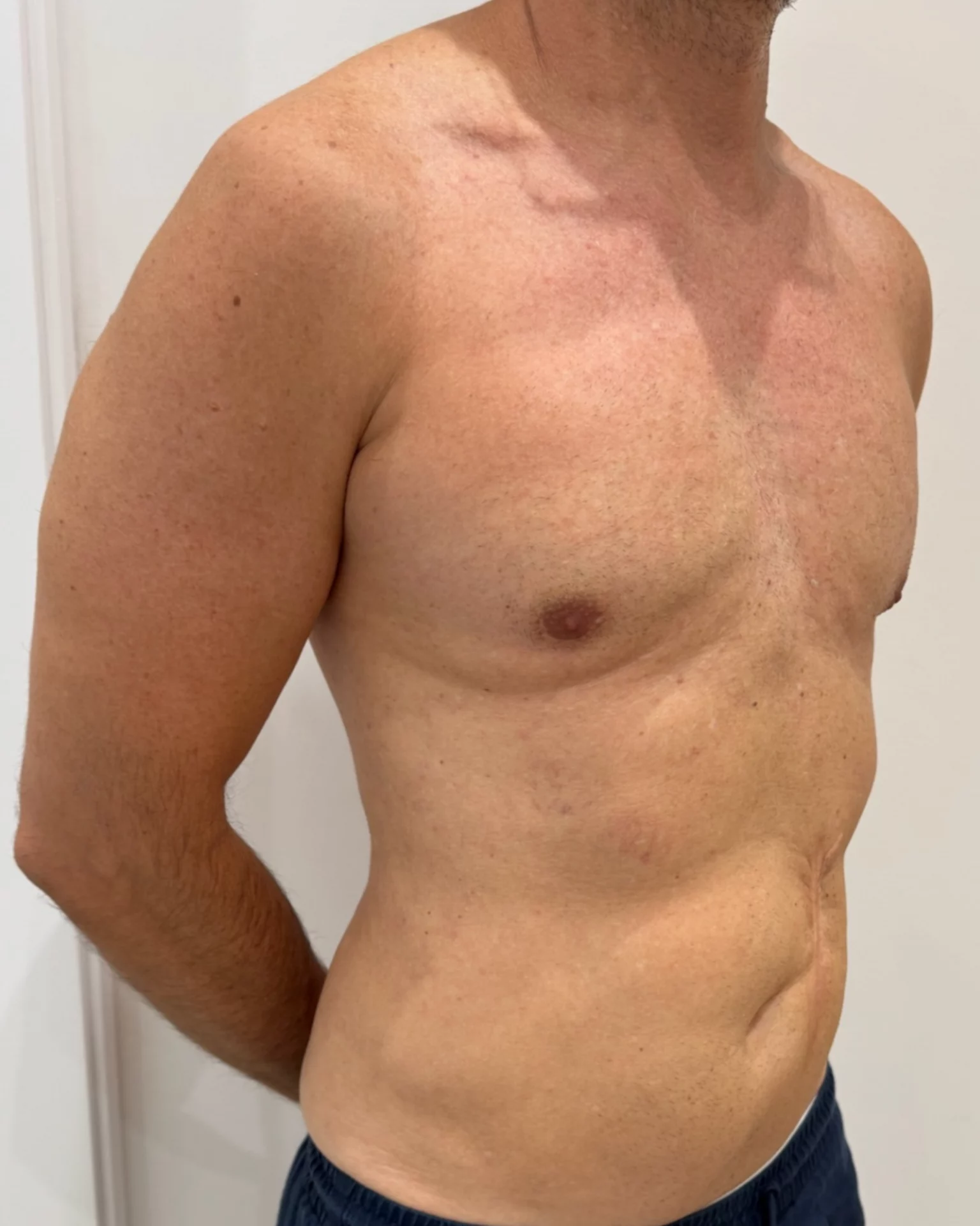 antes y después del tratamiento de ginecomastia