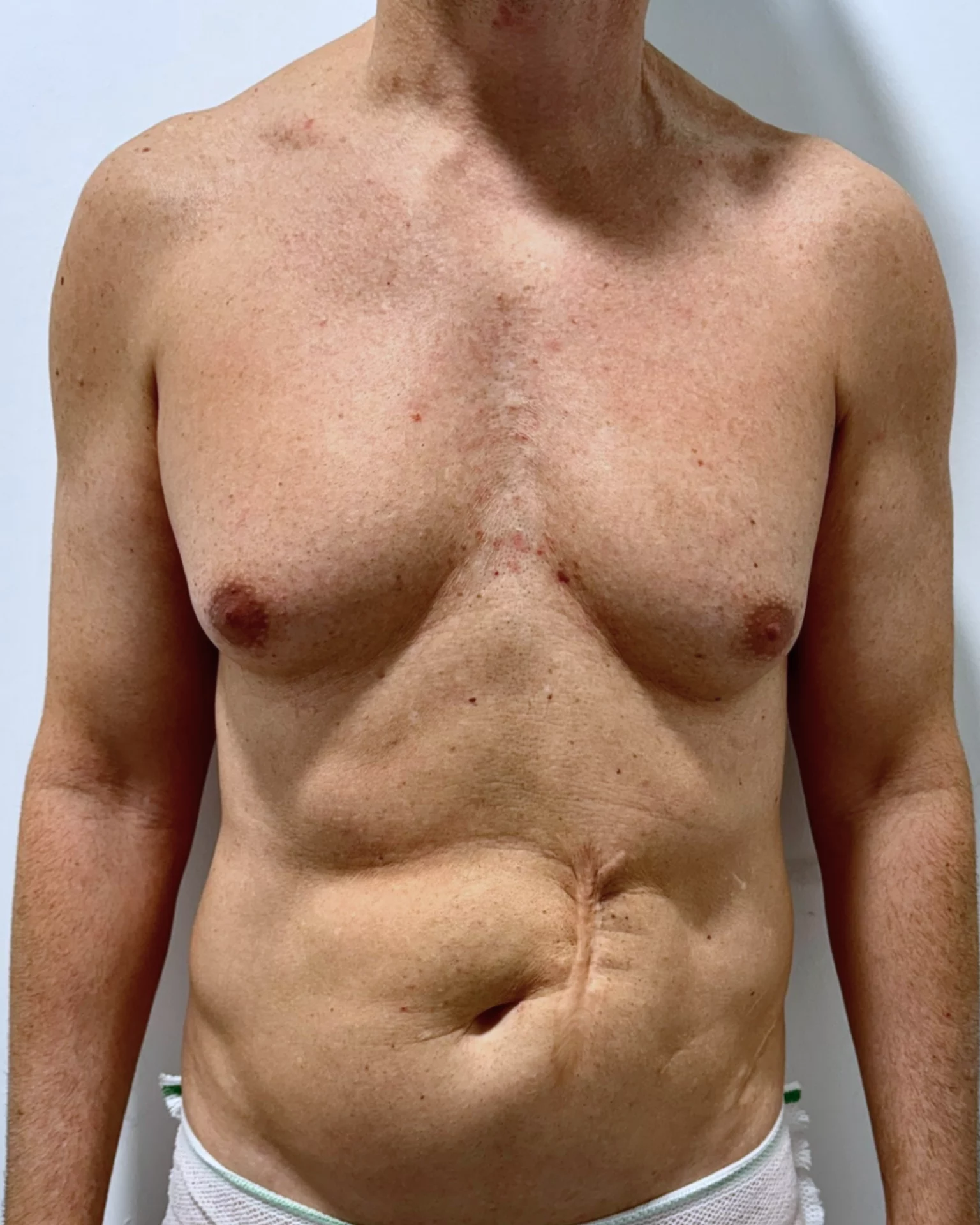 eliminación de grasa por ginecomastia