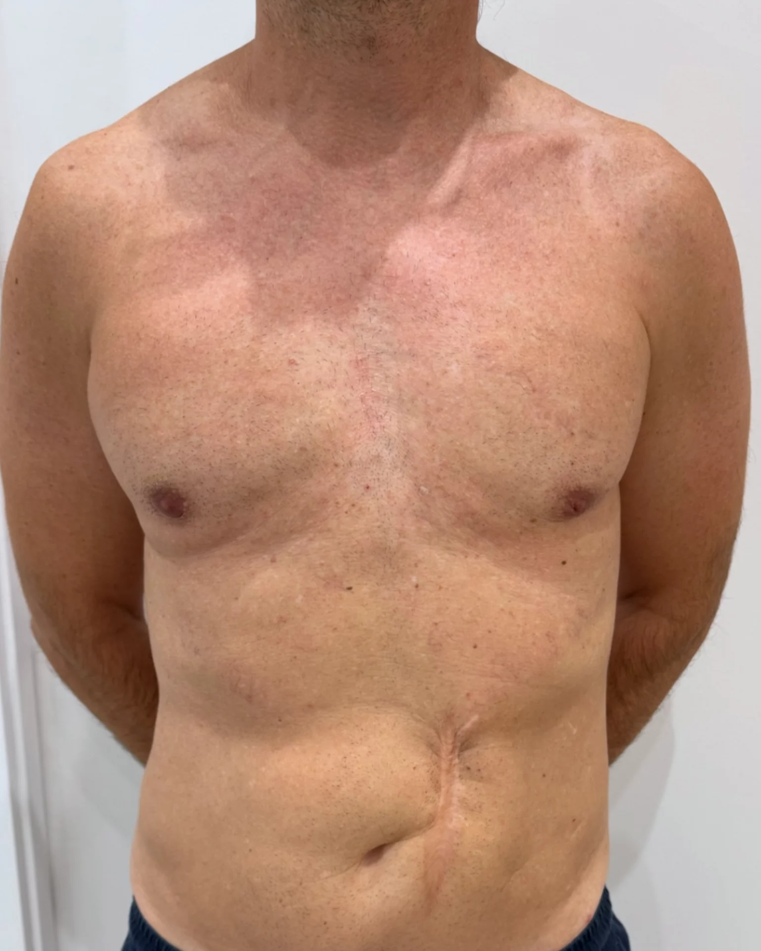 resultados de la cirugía de la ginecomastia