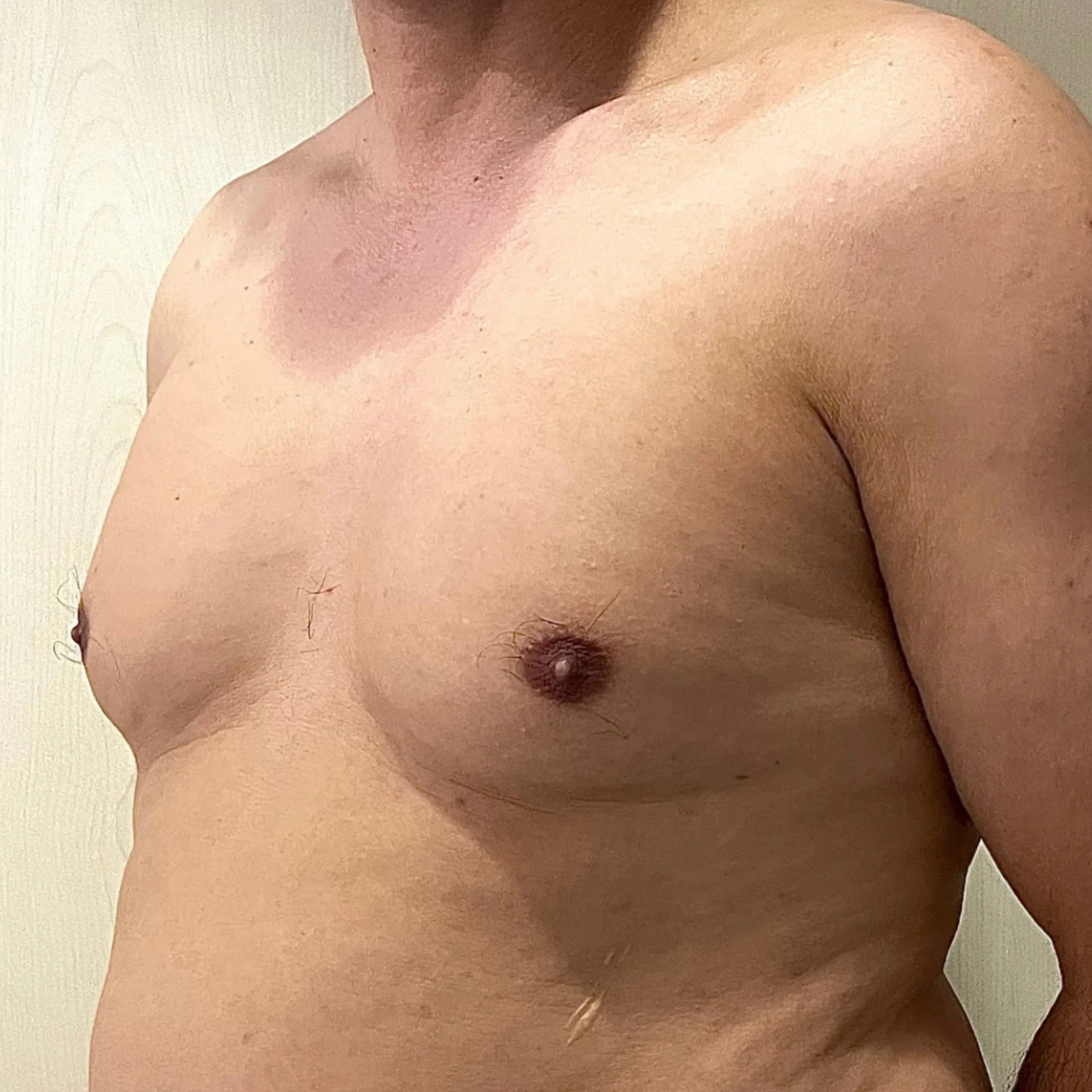 qué es la ginecomastia