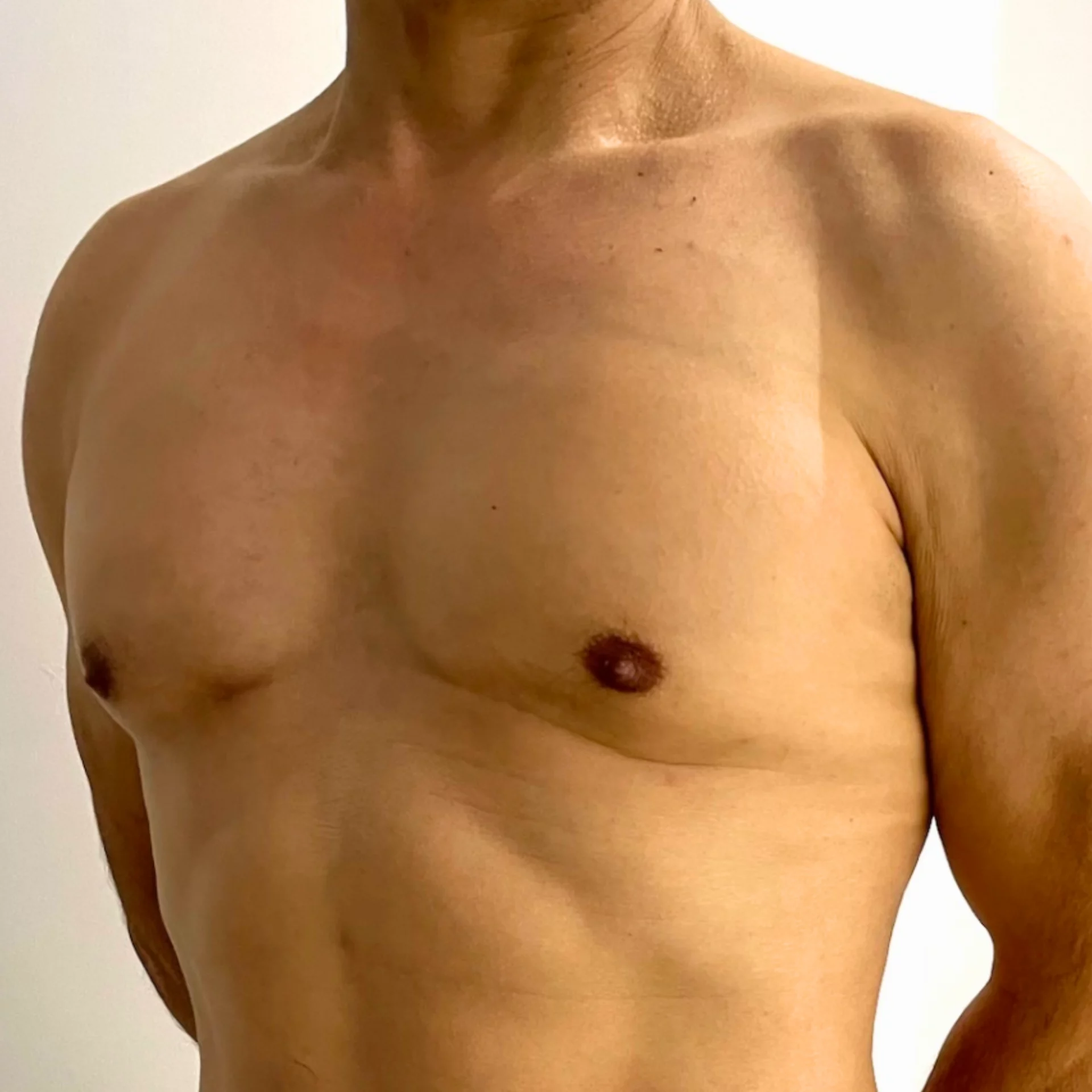 tratamiento contra la ginecomastia