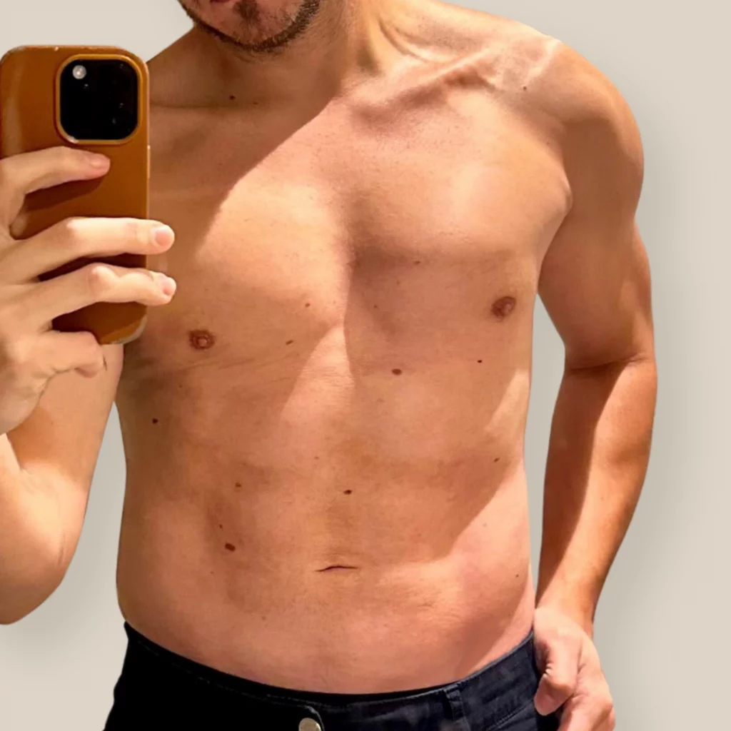 ginecomastia en clínica brasó