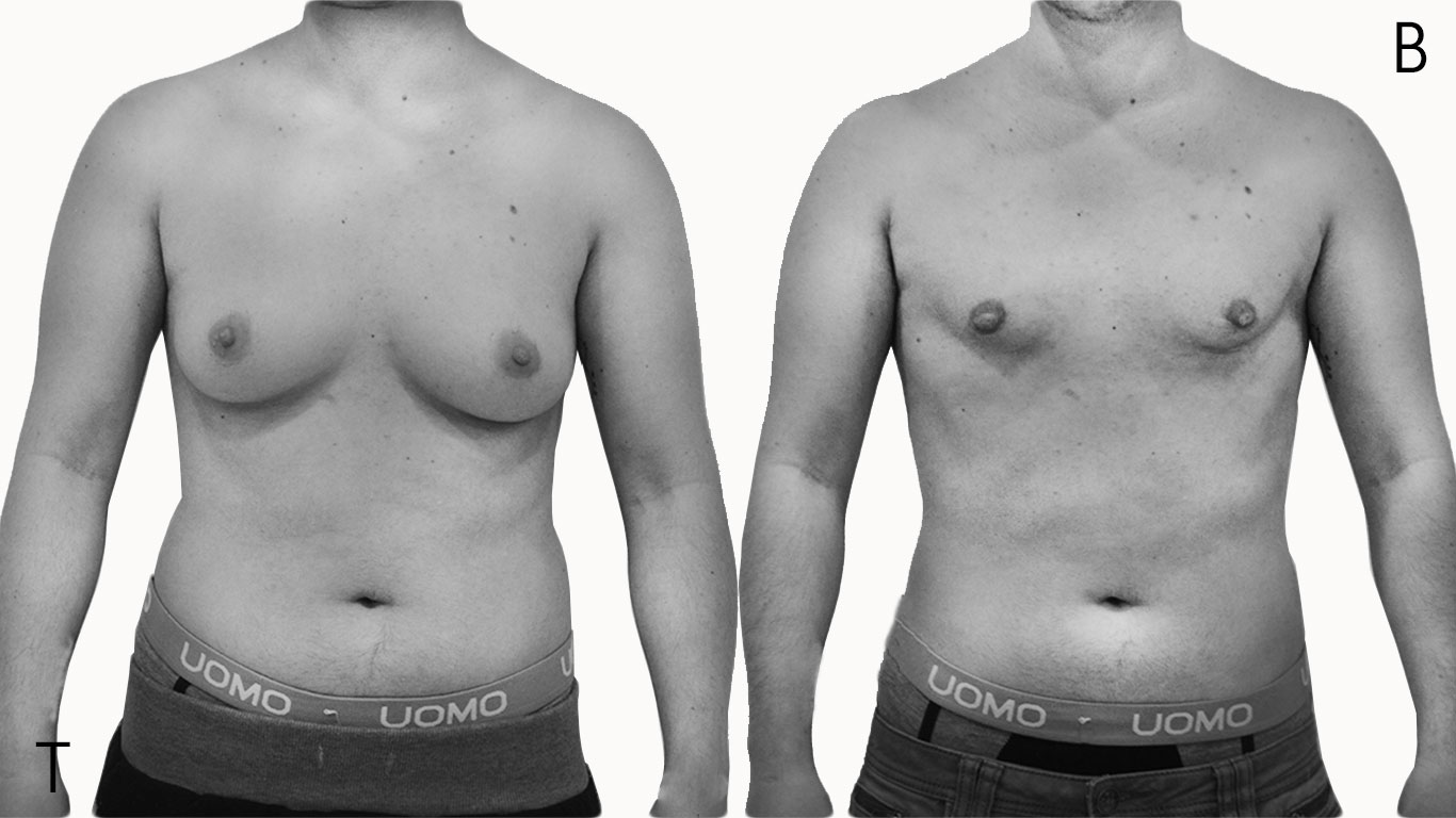 Antes y después mastectomía
