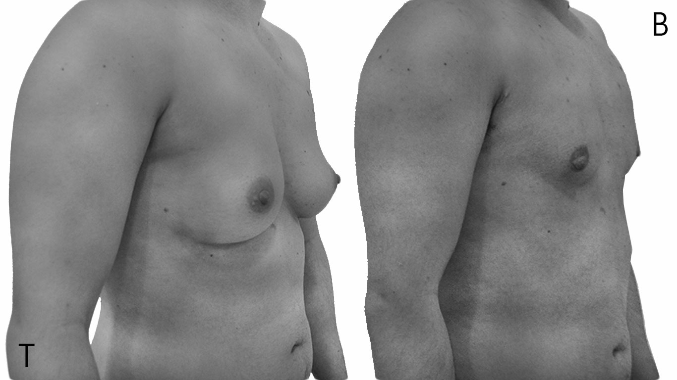 Antes y después mastectomía