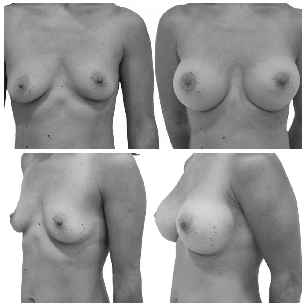 Antes y después mamoplastia de aumento