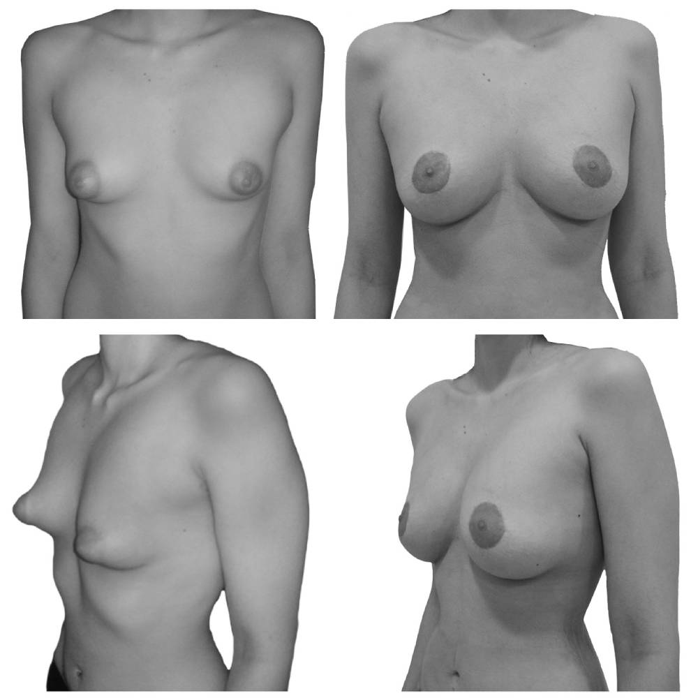 Antes y después mamoplastia de aumento