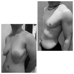 What is mastectomy for transsexual patients
