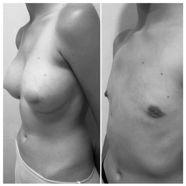 Antes y después mastectomía subcutánea sin cicatriz