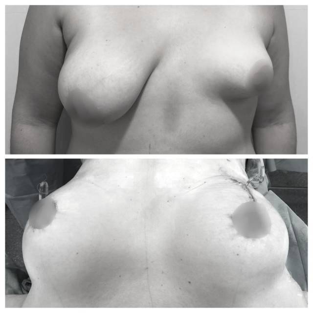 Antes y después: Simetría mamaria con prótesis
